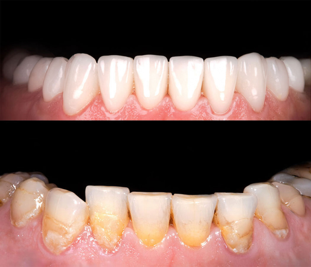 teethwhiteningveneers Peaceful Dental, Brisbane, South Brisbane, Greenbank, Browns Plains